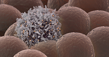 Carcinoma