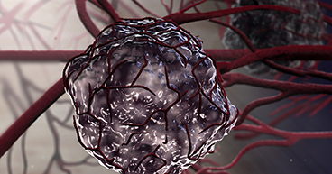 Tumor