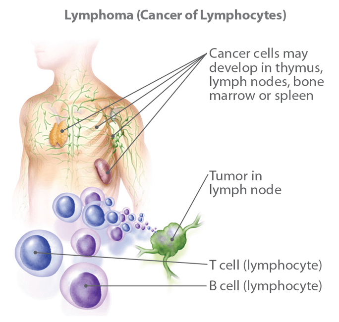 Non-Hodgkin Lymphoma Image