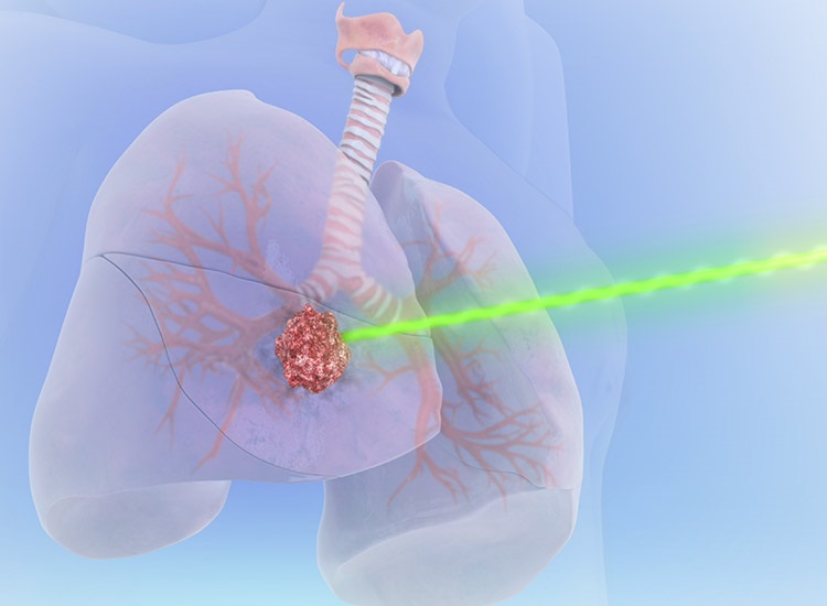 Radiation Therapy for Cancer What to Expect from Treatment CTCA